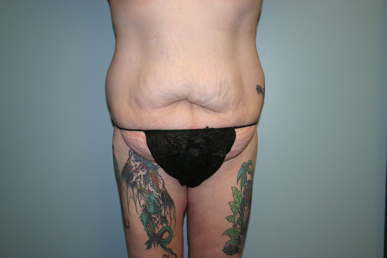 Fat Transfer Before & After