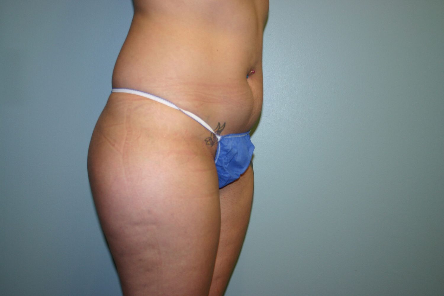 Fat Transfer Before & After