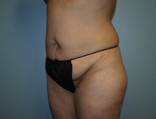 Fat Transfer Before & After