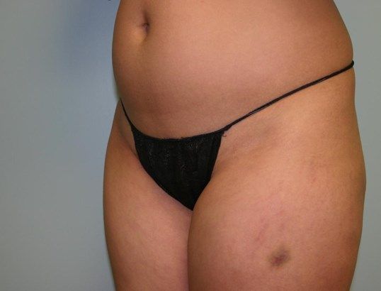 Fat Transfer Before & After