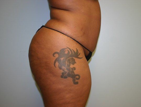 Fat Transfer Before & After