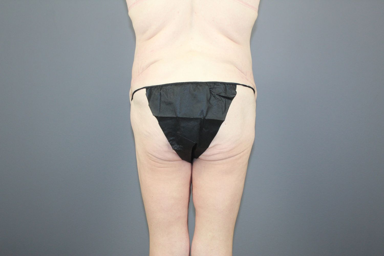 Lower Body Lift Before & After