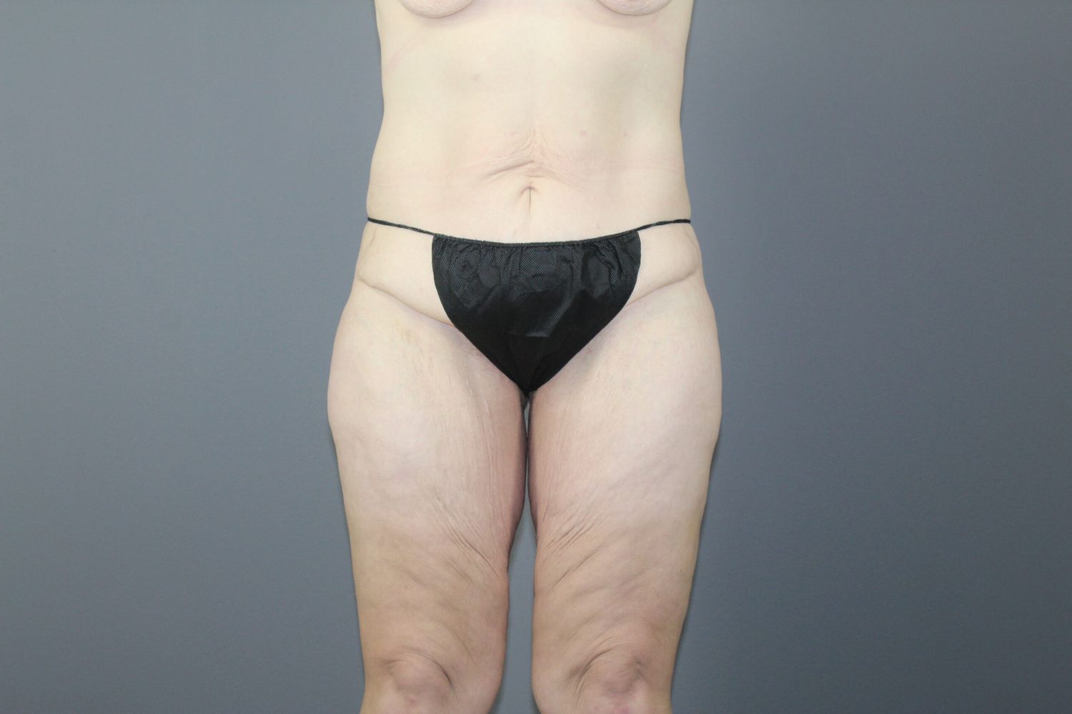 Lower Body Lift Before & After