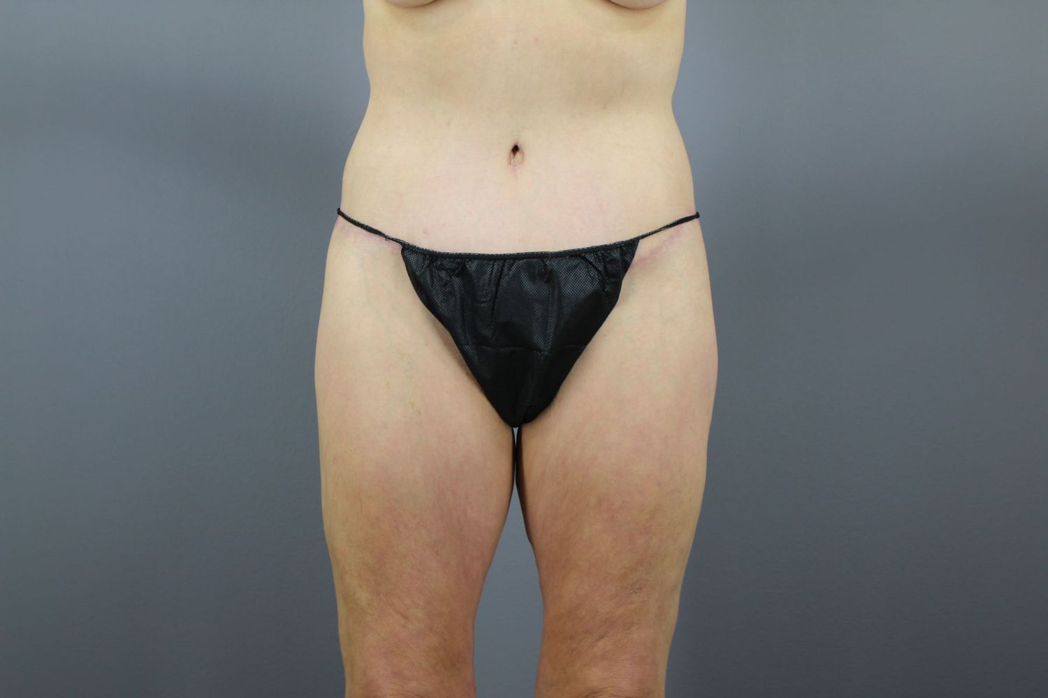 Lower Body Lift Before & After