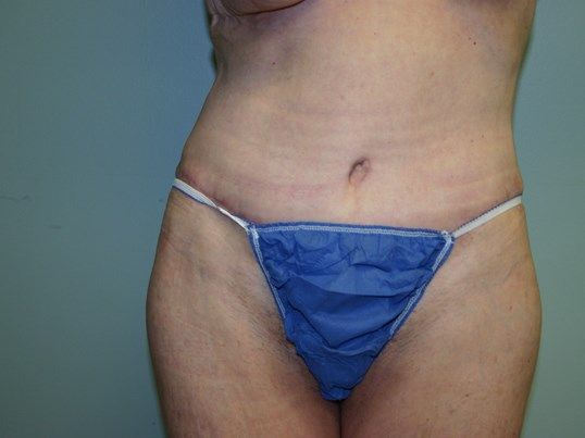 Lower Body Lift Before & After