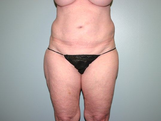 Lower Body Lift Before & After