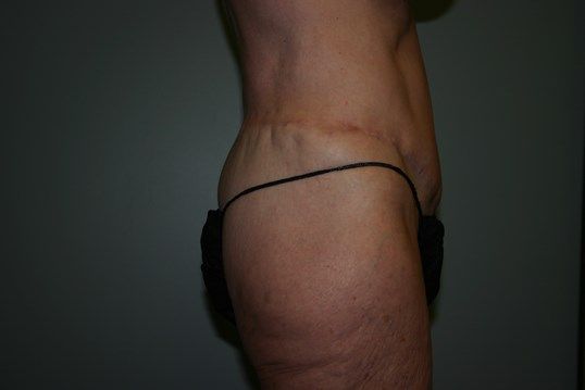 Lower Body Lift Before & After