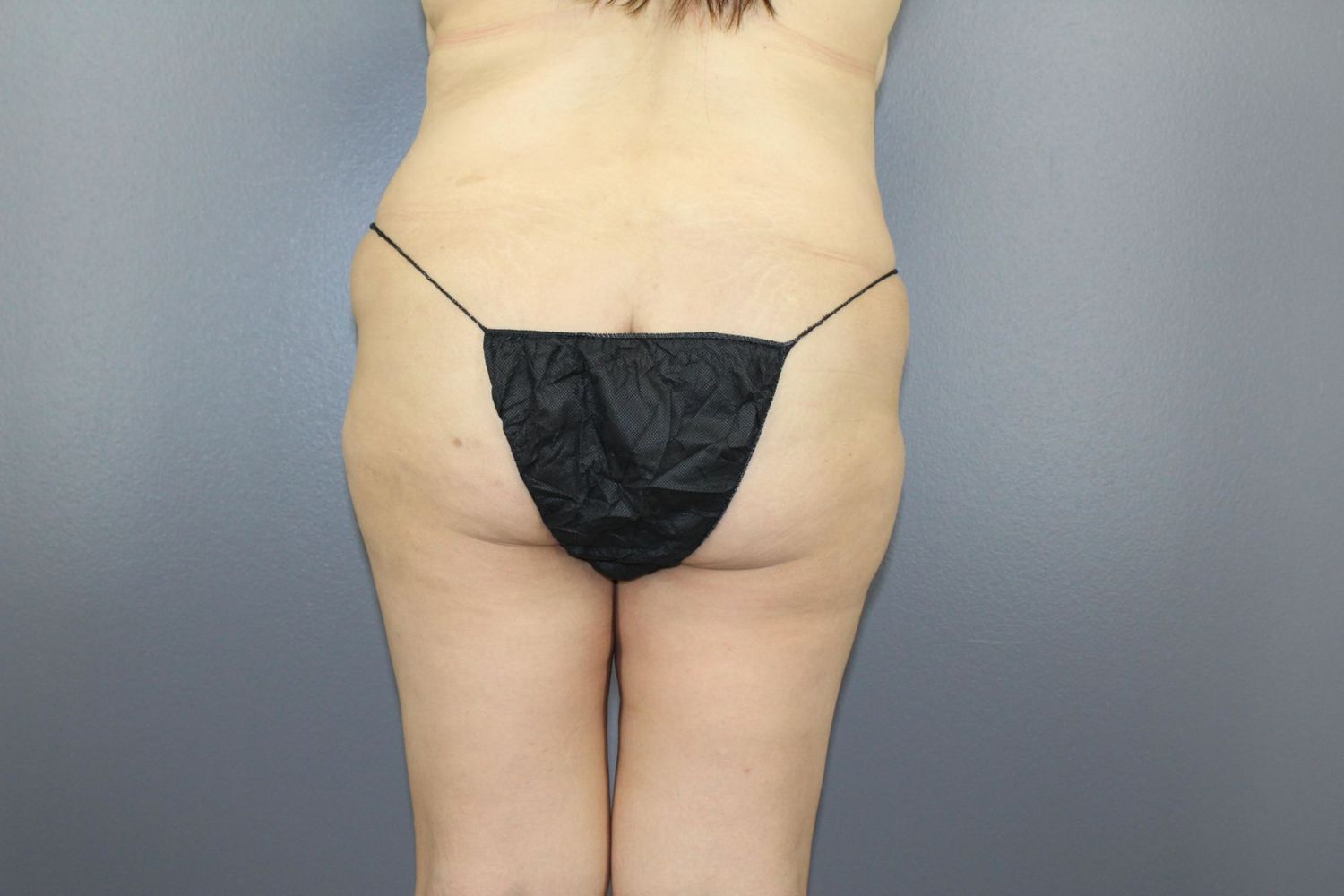 Lower Body Lift Before & After