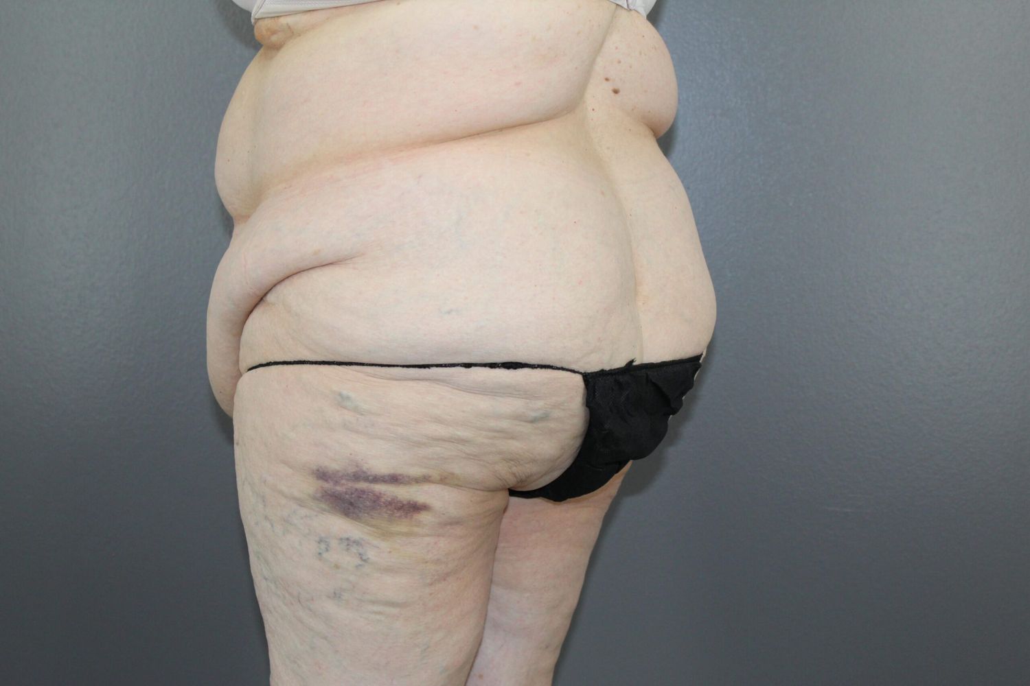 Lower Body Lift Before & After