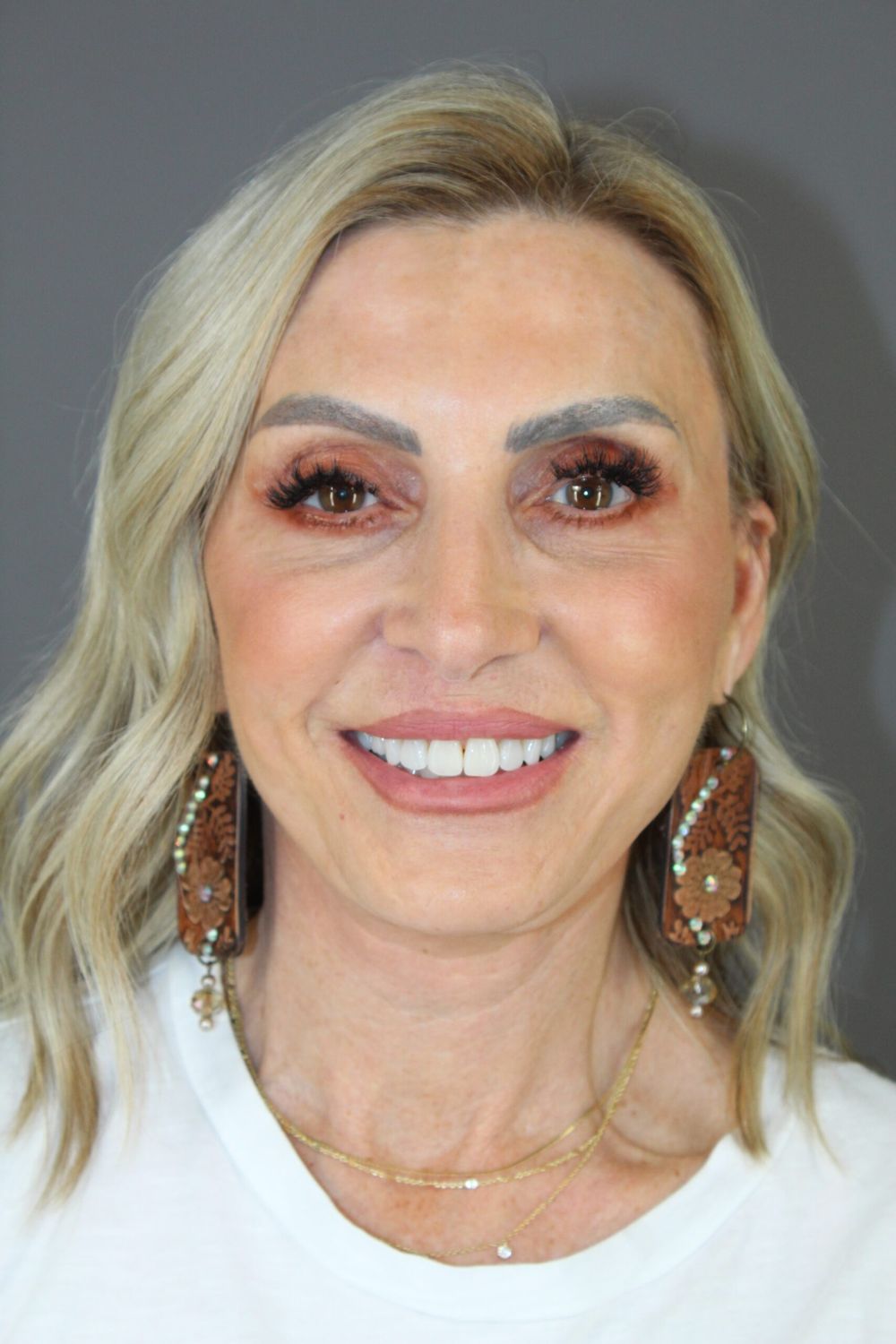 Facial Peels Before & After