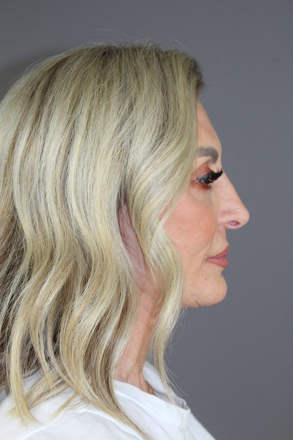 Facial Peels Before & After