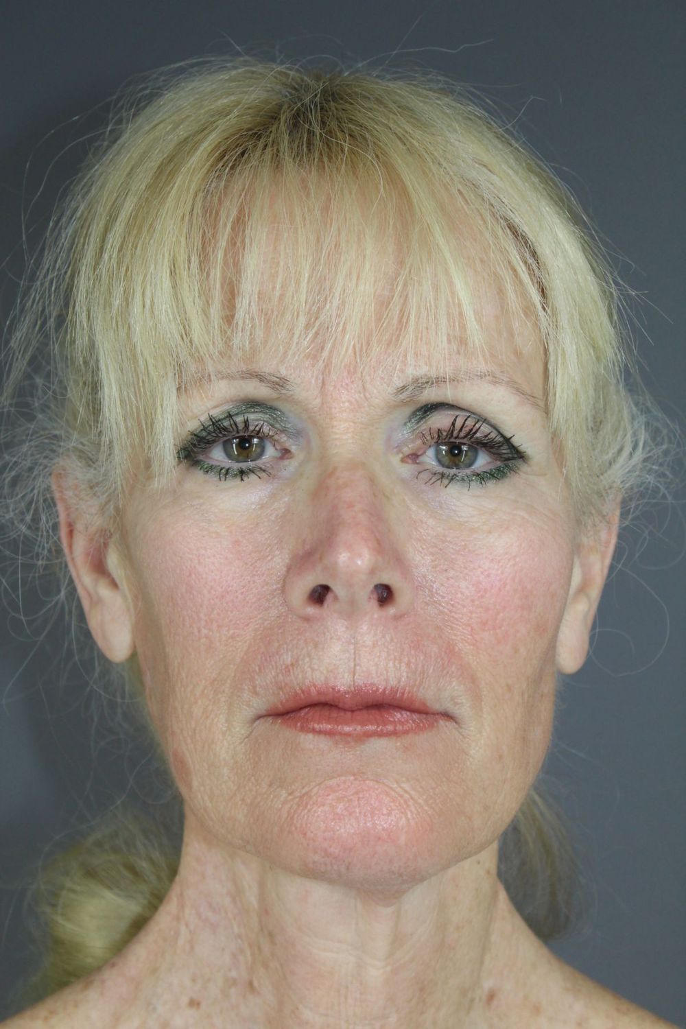 Facial Peels Before & After