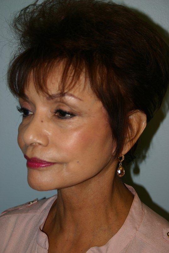 Facial Peels Before & After