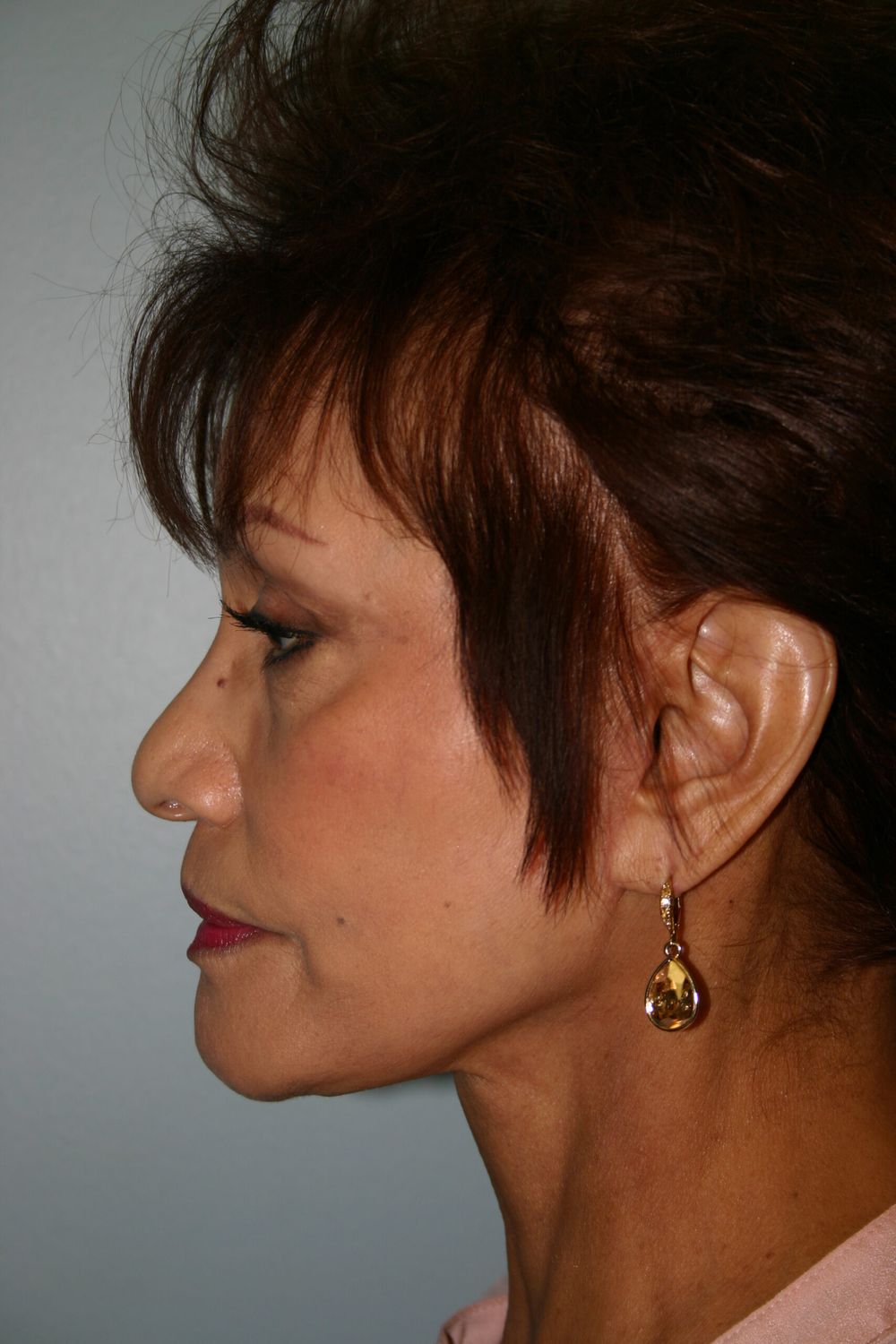 Facial Peels Before & After