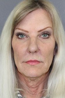 Facial Peels Before & After