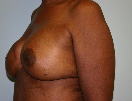 Breast Reconstruction Before & After