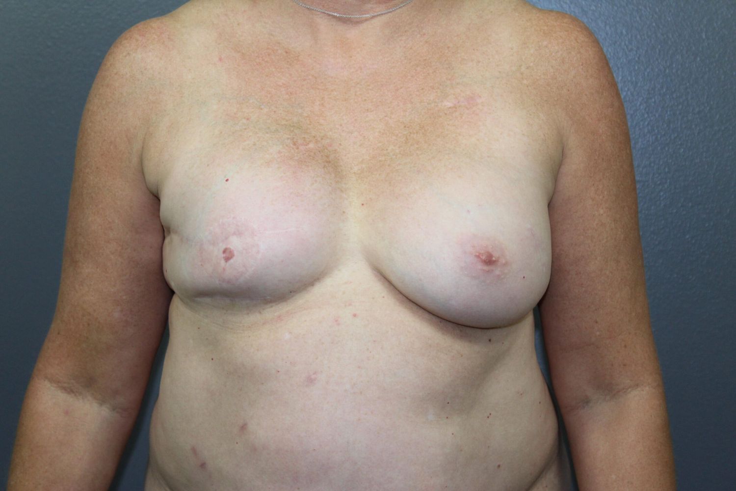 Breast Reconstruction Before & After