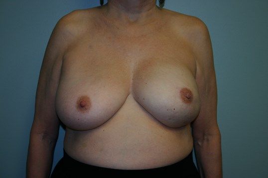 Breast Reconstruction Before & After