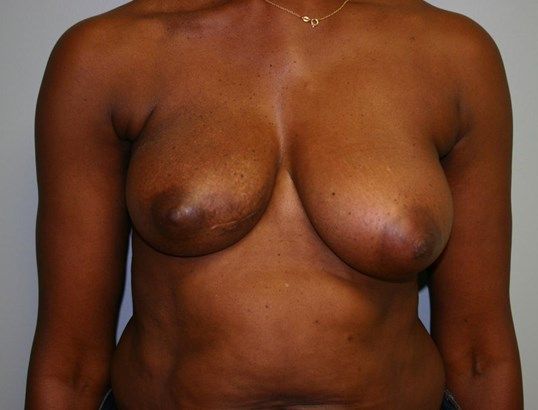 Breast Reconstruction Before & After