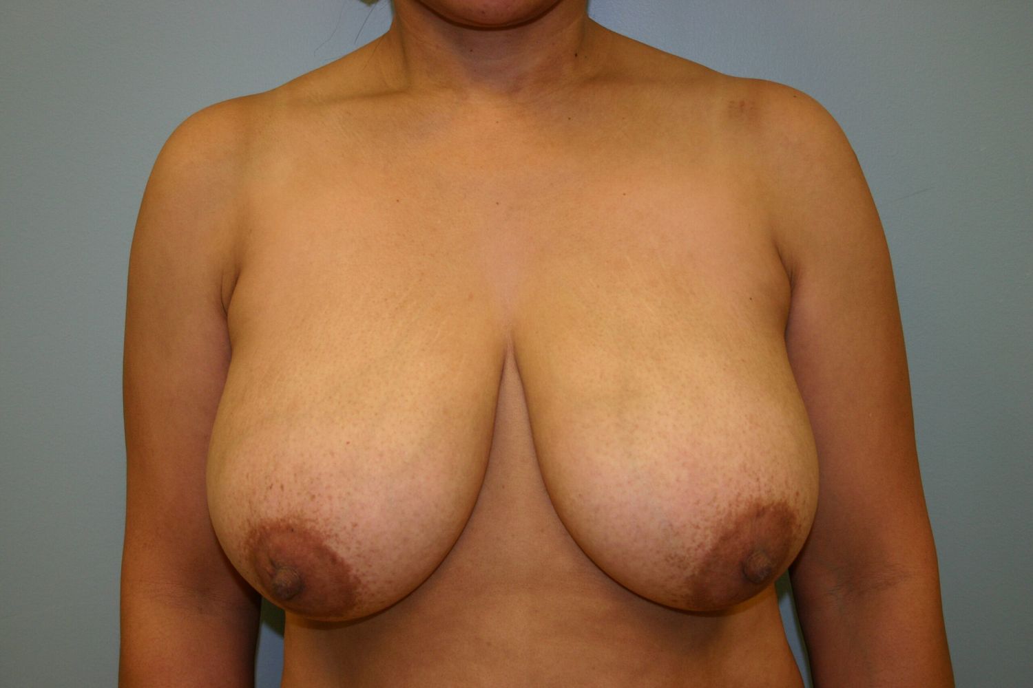Breast Reduction Before & After
