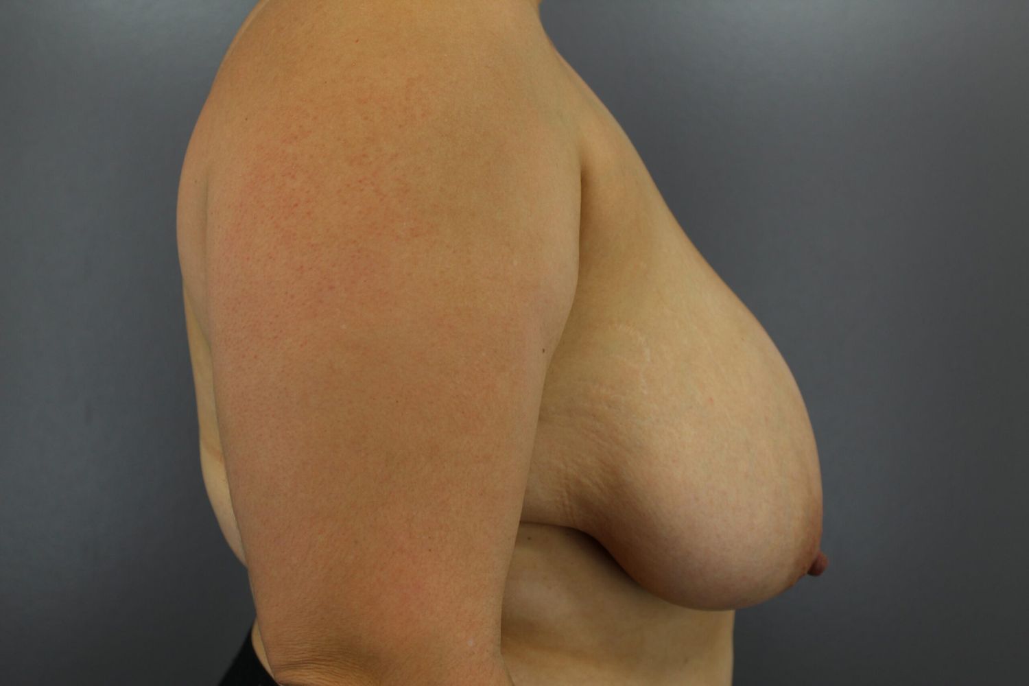 Breast Reduction Before & After