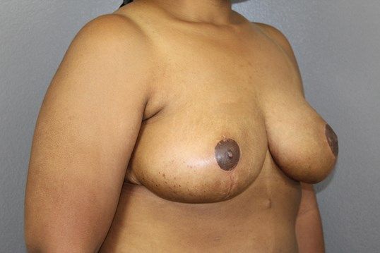 Breast Reduction Before & After