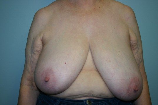 Breast Reduction Before & After