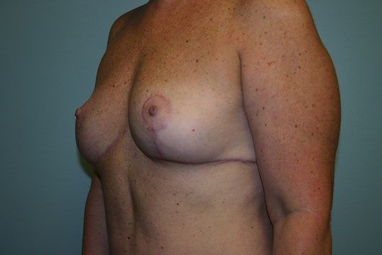 Breast Reduction Before & After