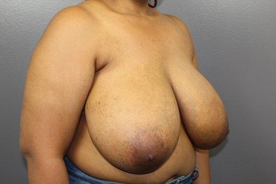 Breast Reduction Before & After