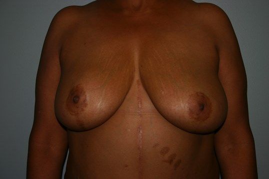 Breast Reduction Before & After