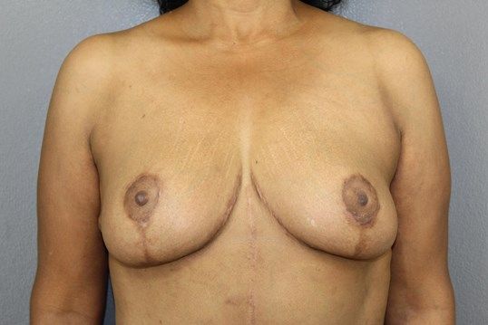 Breast Reduction Before & After
