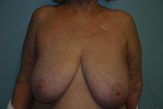 Breast Reduction Before & After