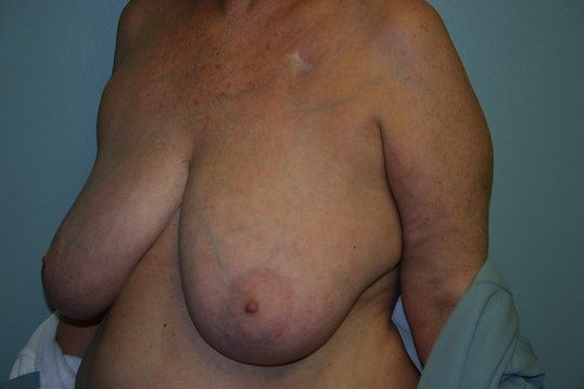 Breast Reduction Before & After