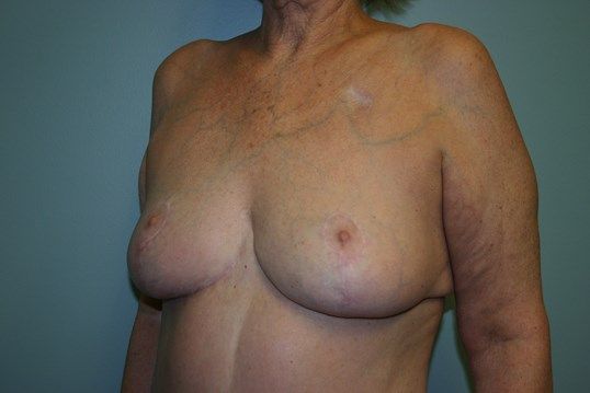 Breast Reduction Before & After