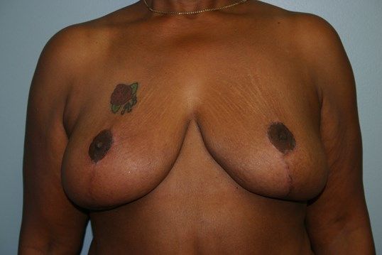 Breast Reduction Before & After