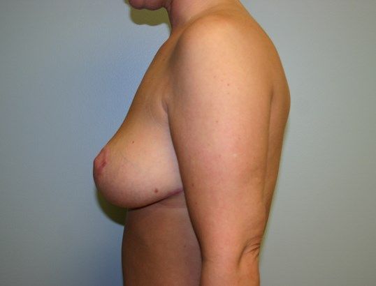 Breast Reduction Before & After