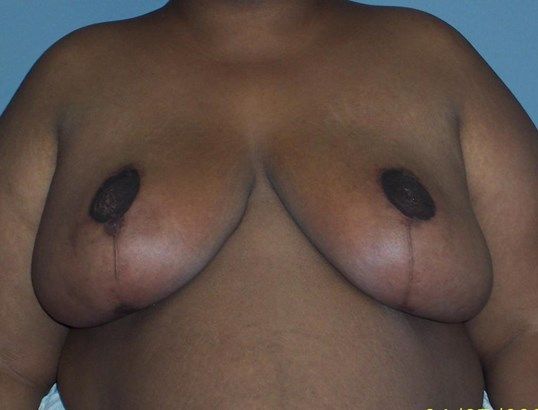 Breast Reduction Before & After