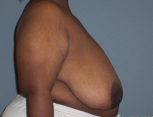 Breast Reduction Before & After