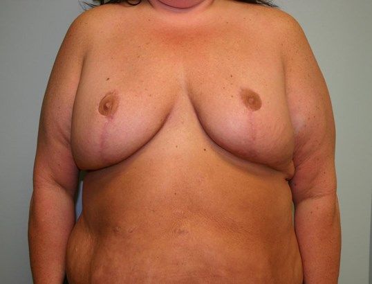 Breast Reduction Before & After