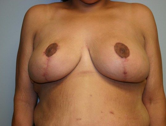 Breast Reduction Before & After