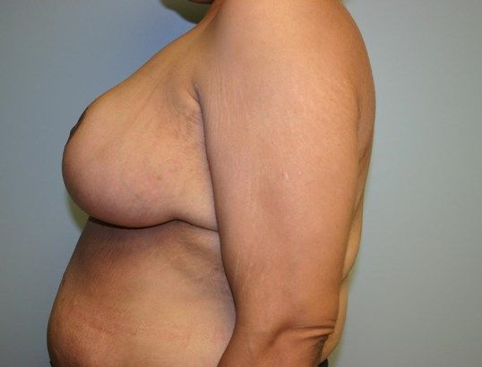 Breast Reduction Before & After