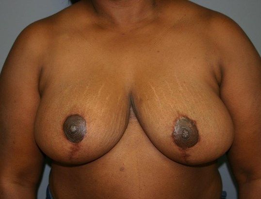 Breast Reduction Before & After