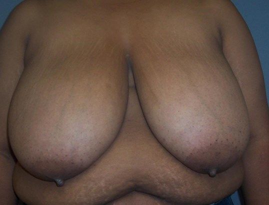 Breast Reduction Before & After