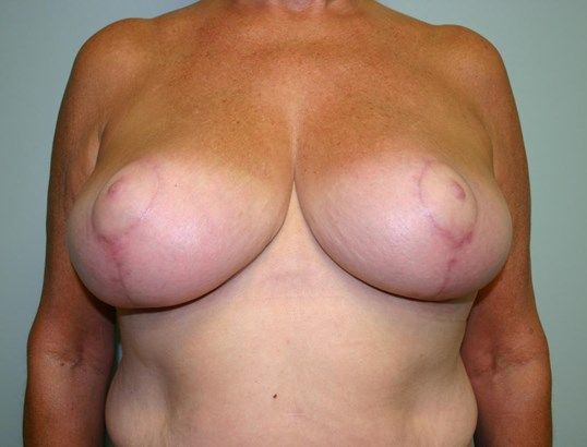 Breast Reduction Before & After
