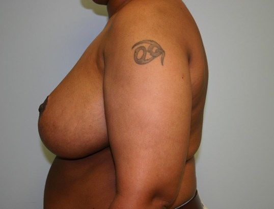 Breast Reduction Before & After
