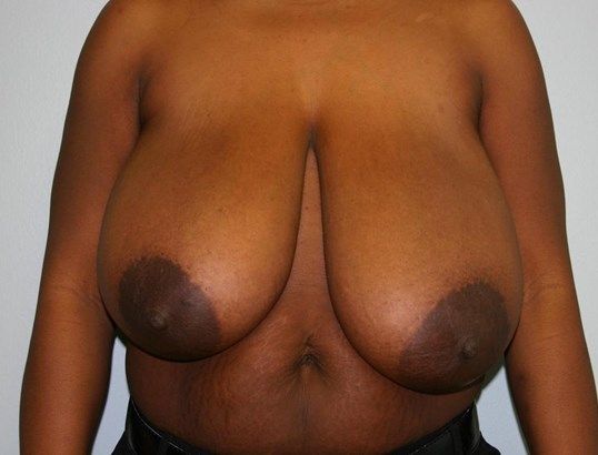 Breast Reduction Before & After