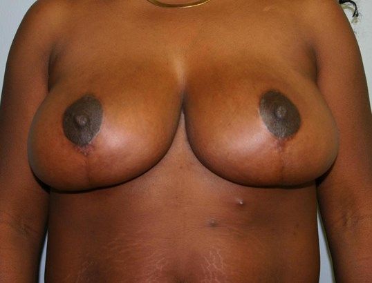 Breast Reduction Before & After