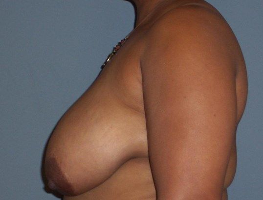 Breast Reduction Before & After