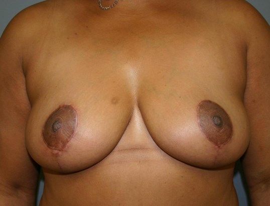 Breast Reduction Before & After