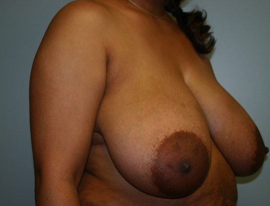 Breast Reduction Before & After